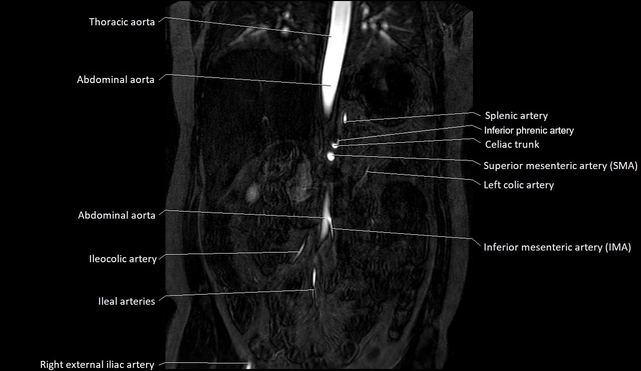MRA Abdomen coronal anatomy image 16.webp